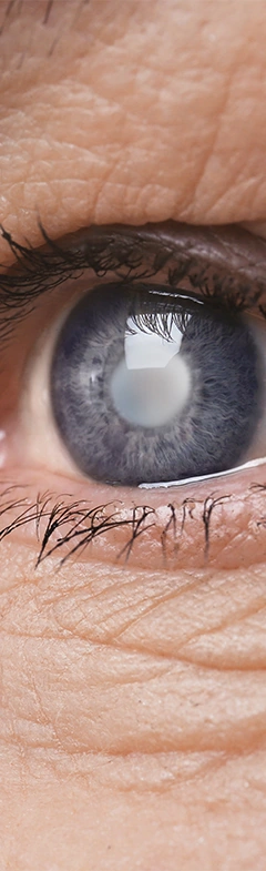 cataract eye up close